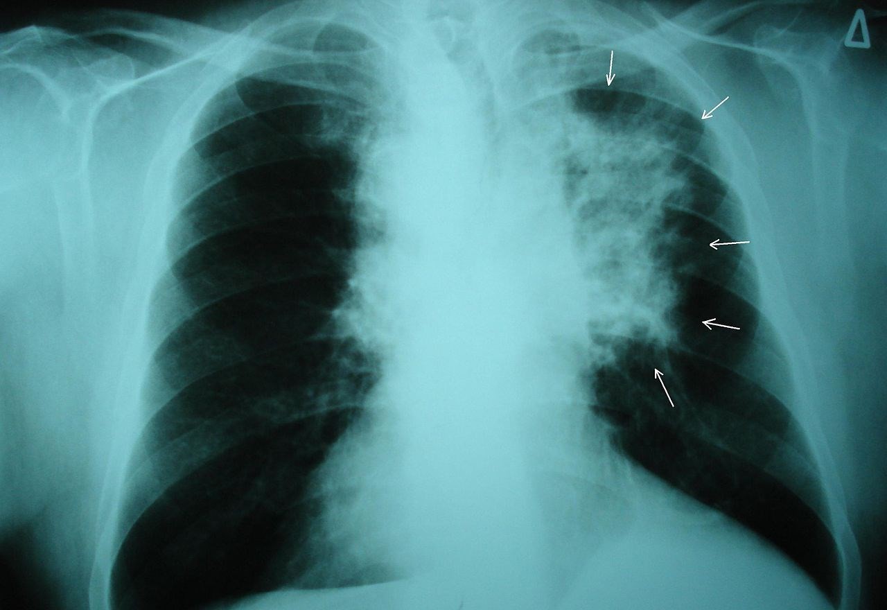 Radiografía en la que puede verse un cáncer de pulmón