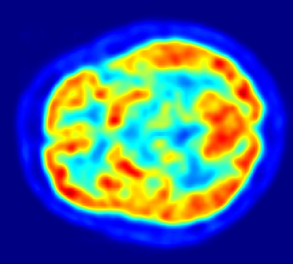 Tomografía que muestra la actividad cerebral de un paciente de parkinson